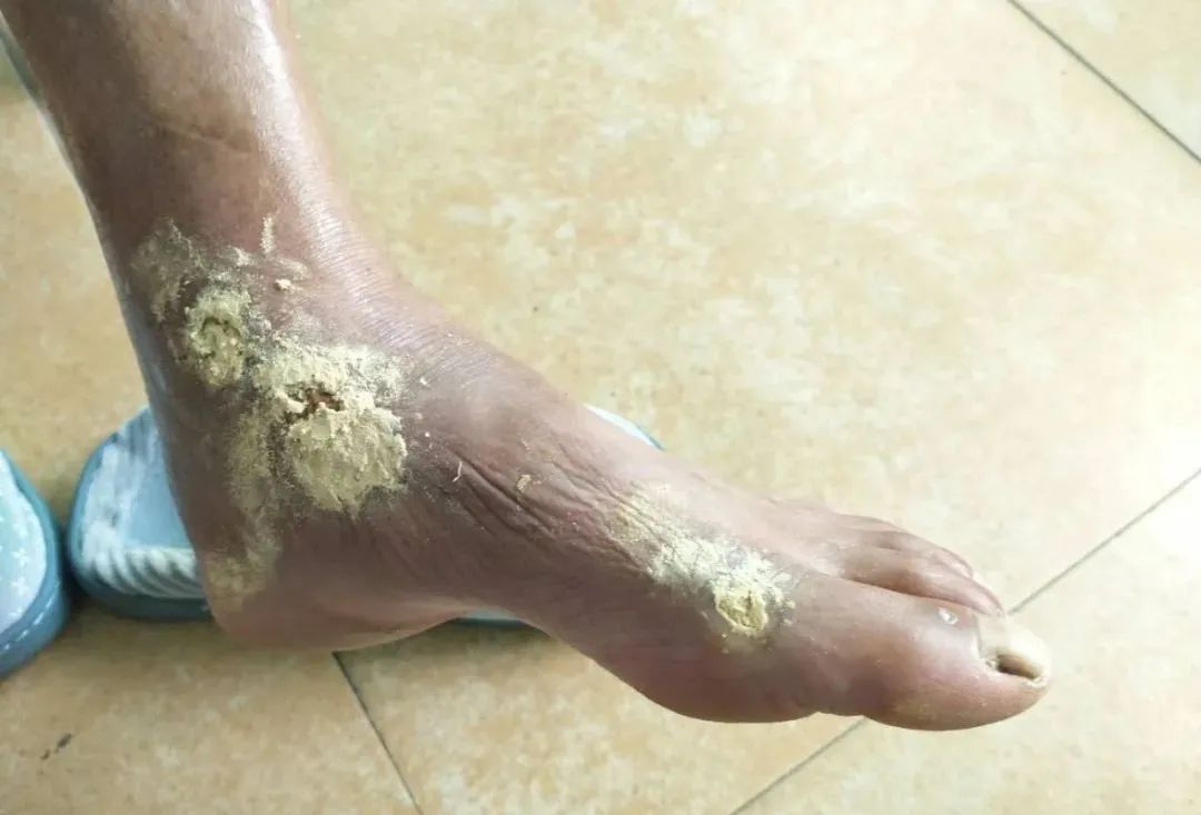 【原始点案例】原始点调理老人意外摔伤不能走路案例！