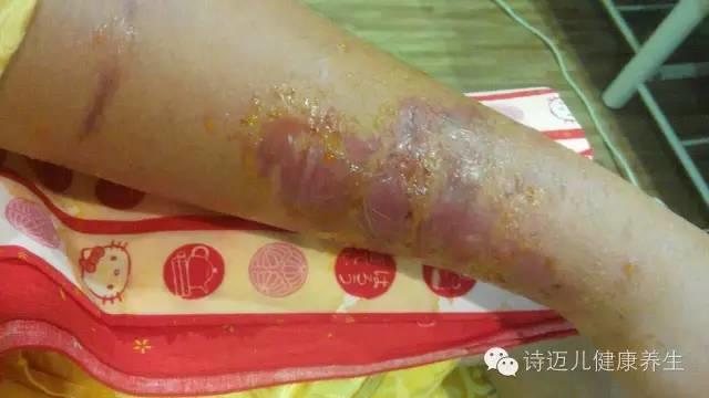 案例分享:原始点调理蛇毒的成功案例 案例分享:原始点调理蛇毒的成功案例