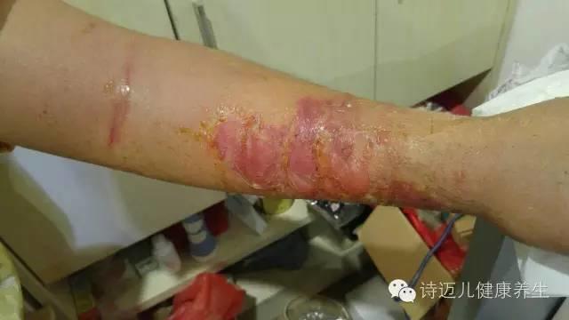 案例分享:原始点调理蛇毒的成功案例 案例分享:原始点调理蛇毒的成功案例