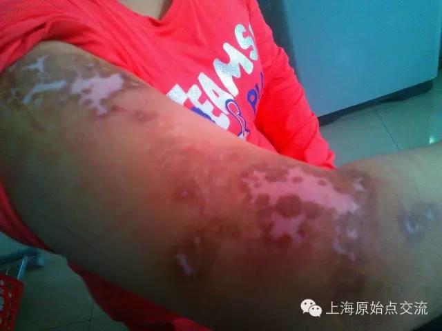 原始点治疗白癜风案例 原始点治疗白癜风案例