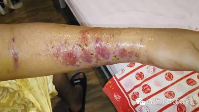 案例分享:原始点调理蛇毒的成功案例 案例分享:原始点调理蛇毒的成功案例