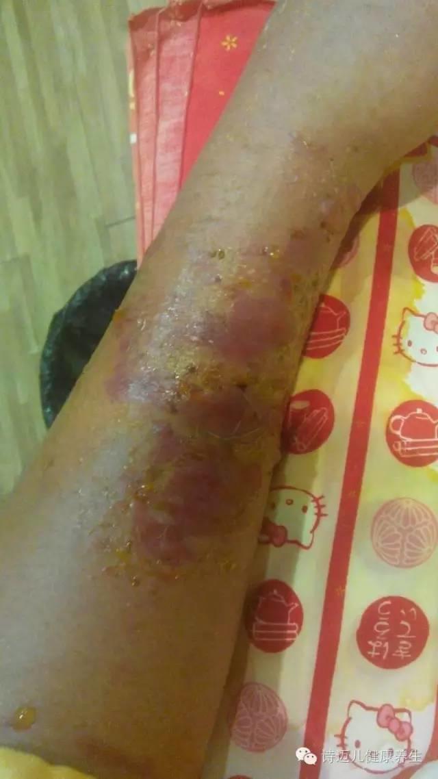 案例分享:原始点调理蛇毒的成功案例 案例分享:原始点调理蛇毒的成功案例