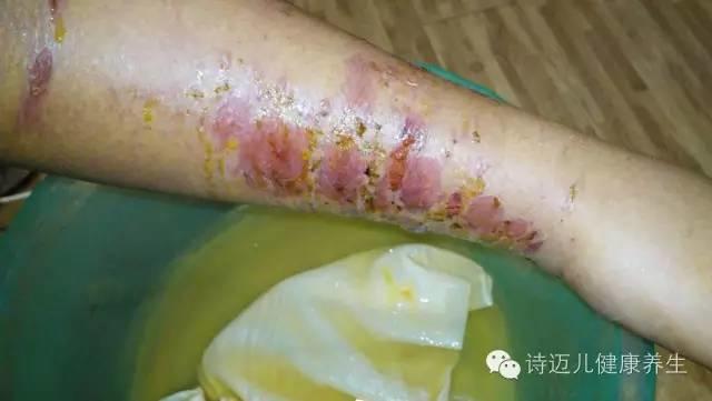 案例分享:原始点调理蛇毒的成功案例 案例分享:原始点调理蛇毒的成功案例