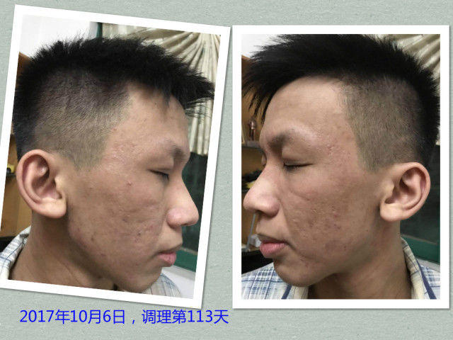 原始点调理严重湿疹:找回帅气的自己 原始点调理严重湿疹:找回帅气的自己