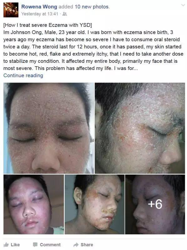 原始点调理23年严重湿疹:《21天的震撼》 原始点调理23年严重湿疹:《21天的震撼》