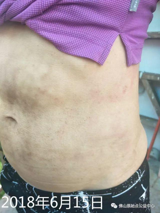 原始点调理带状疱疹:轻松快捷效果好 原始点调理带状疱疹:轻松快捷效果好