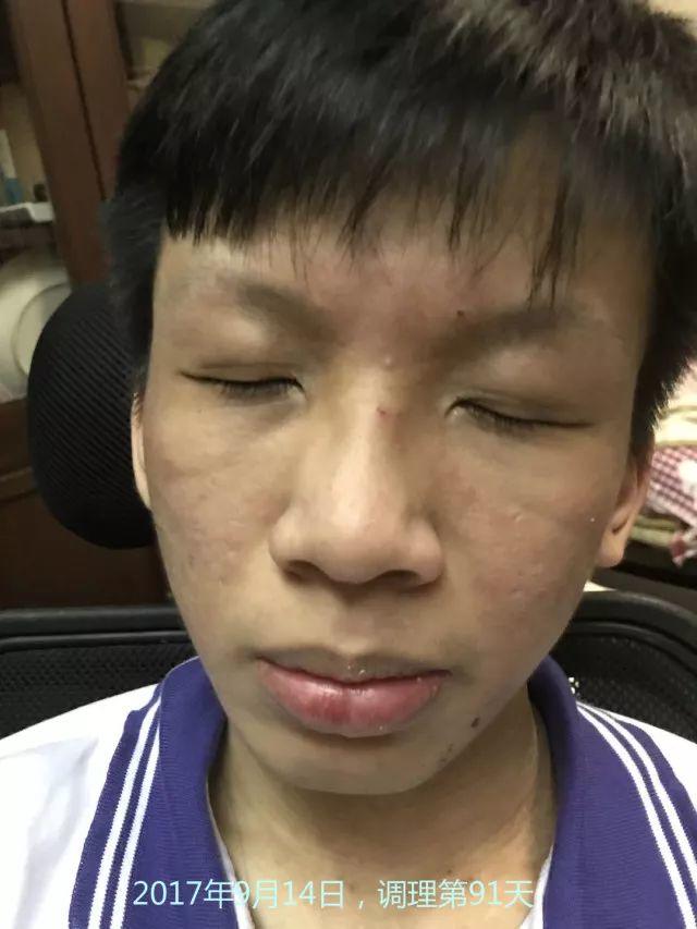 原始点调理严重湿疹:找回帅气的自己 原始点调理严重湿疹:找回帅气的自己