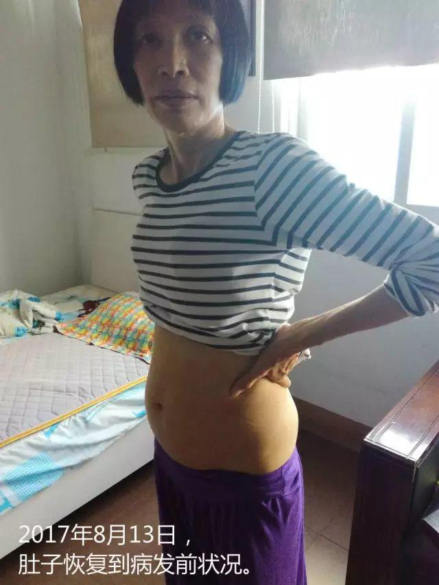 原始点调理腹水双下肢水肿：清晰的观念+信心 成就健康