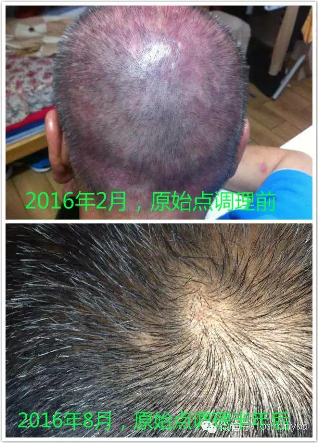 触目惊心  原始点调理八年病史牛皮癣，半年基本恢复健康