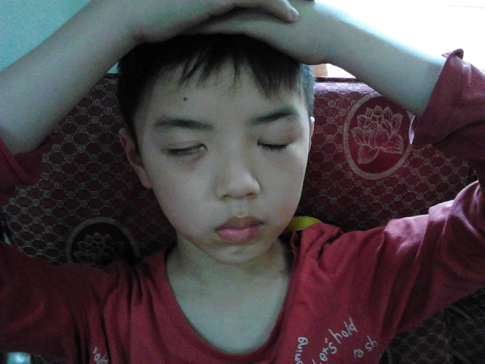 用原始点理疗病毒性脑炎后遗症三个月好了一大半