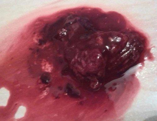 原始点成功助排子宫终止妊娠胎儿 原始点成功助排子宫终止妊娠胎儿