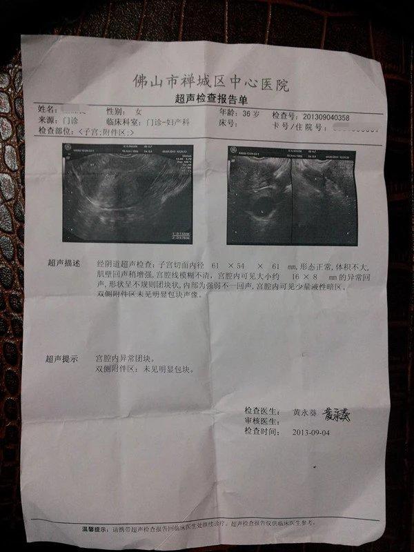 原始点成功助排子宫终止妊娠胎儿 原始点成功助排子宫终止妊娠胎儿