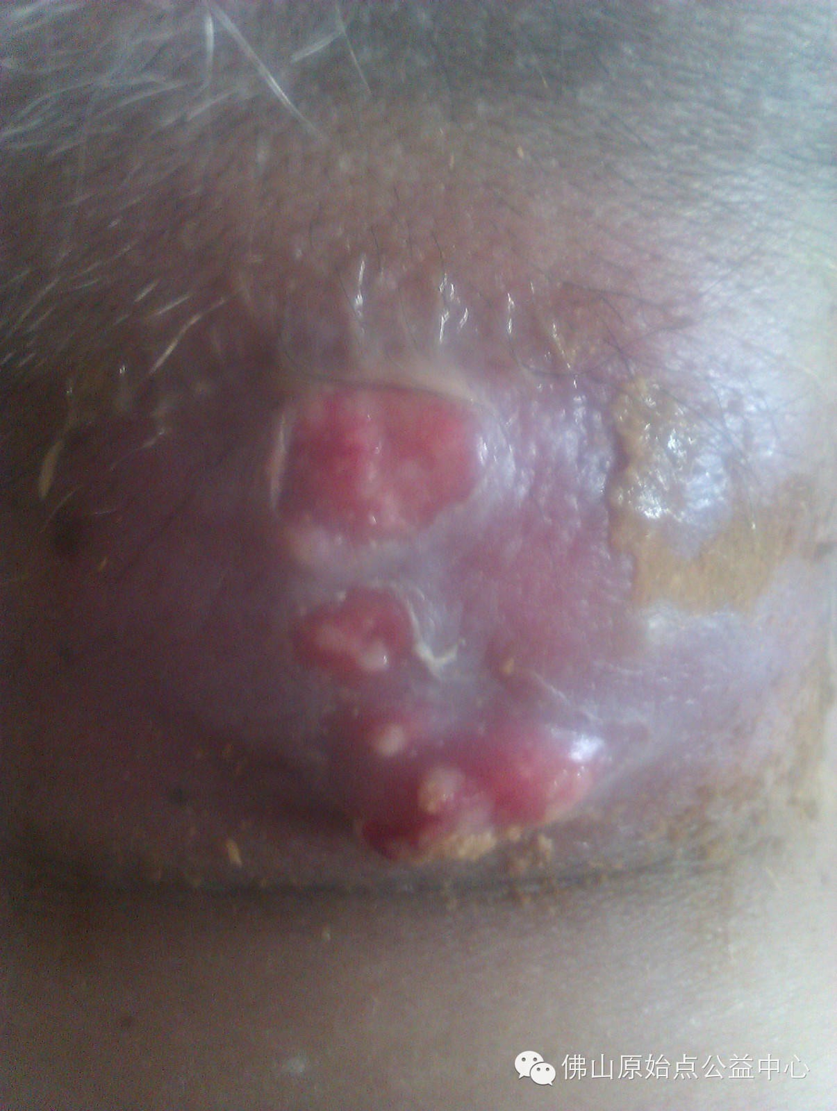 十几年对口疮  原始点调理27天康复