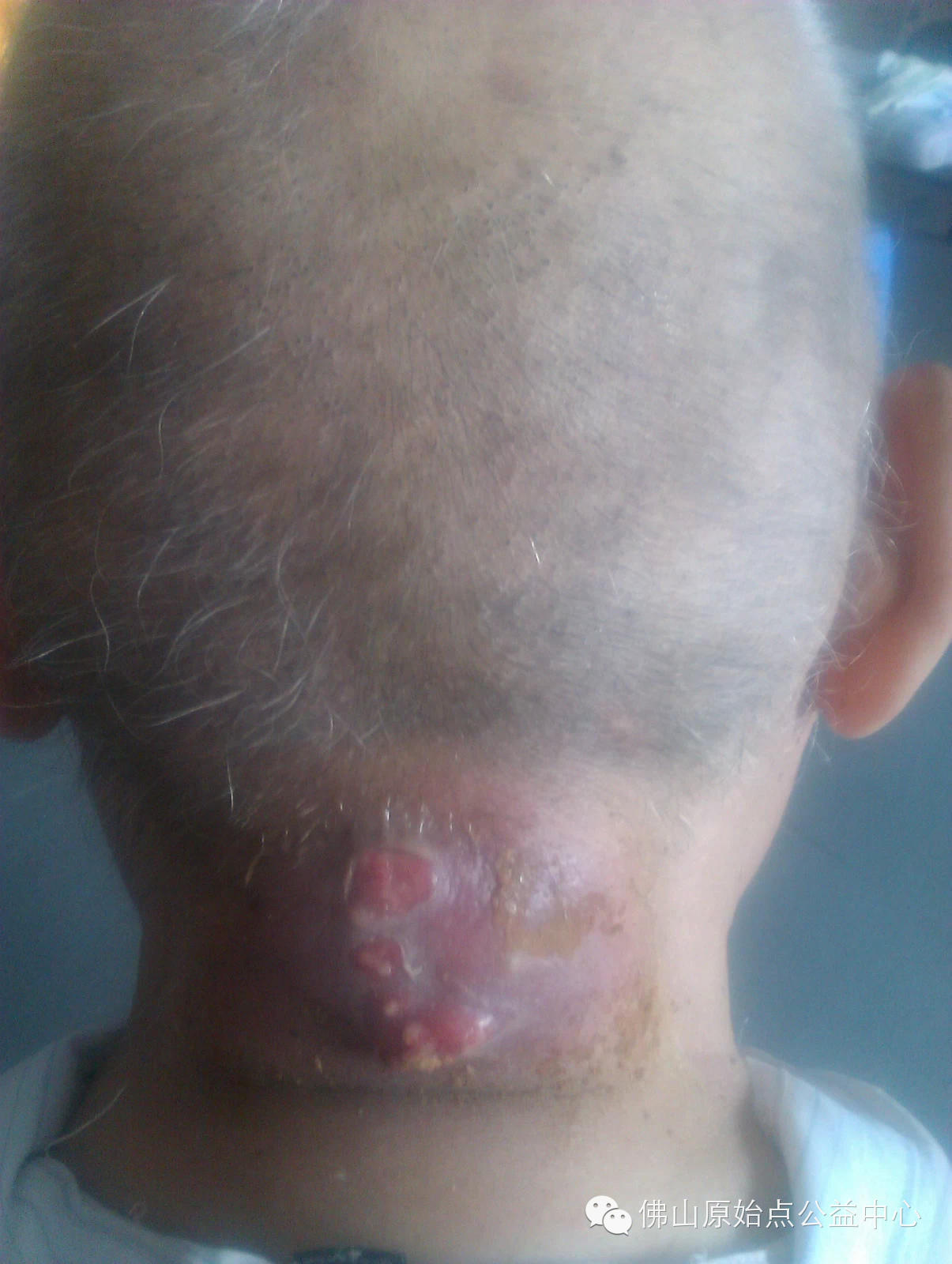 十几年对口疮  原始点调理27天康复