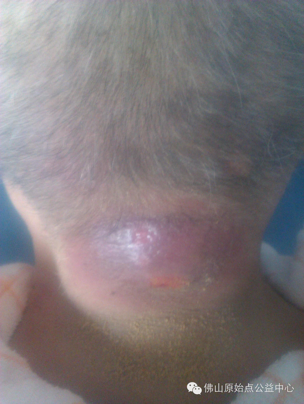 十几年对口疮  原始点调理27天康复