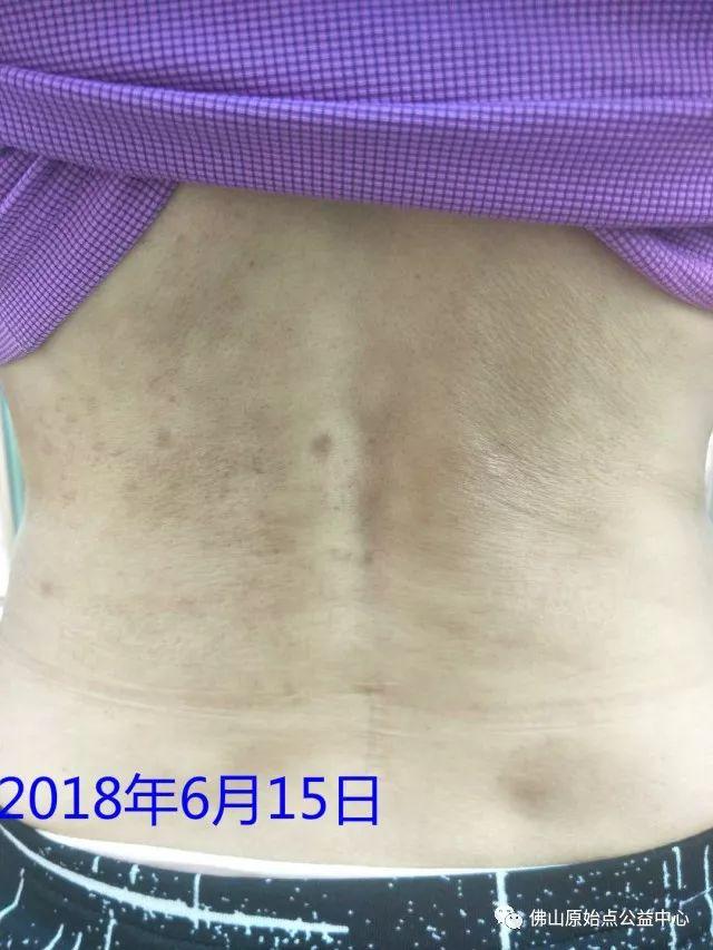 原始点调理带状疱疹:轻松快捷效果好 原始点调理带状疱疹:轻松快捷效果好