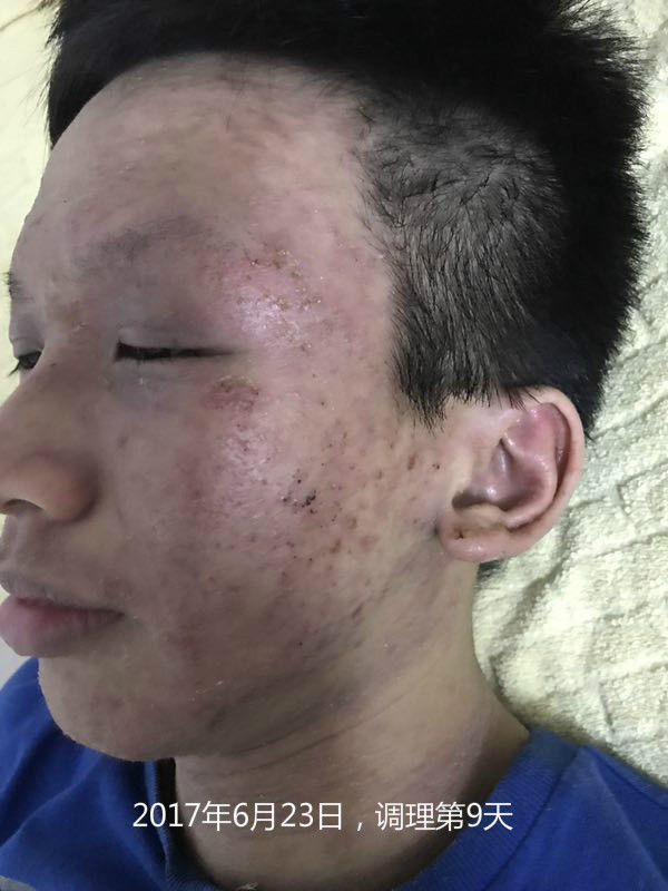 原始点调理严重湿疹:找回帅气的自己 原始点调理严重湿疹:找回帅气的自己