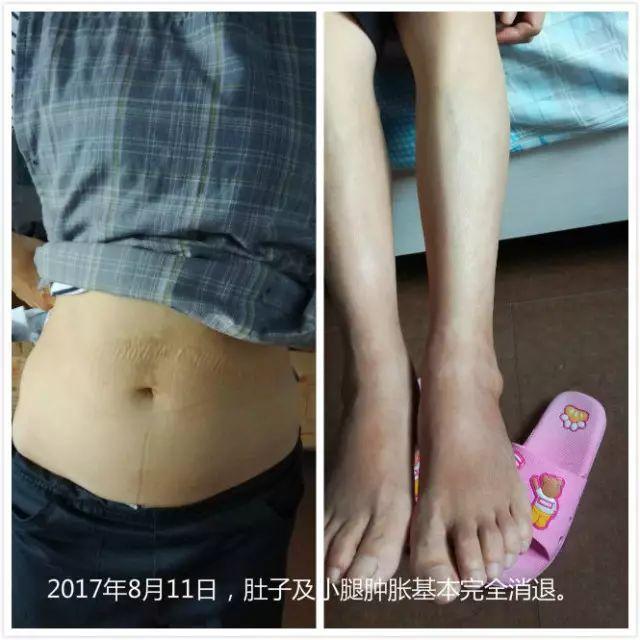 原始点调理腹水双下肢水肿：清晰的观念+信心 成就健康