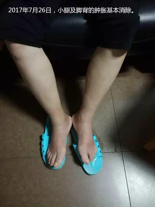 原始点调理腹水双下肢水肿：清晰的观念+信心 成就健康