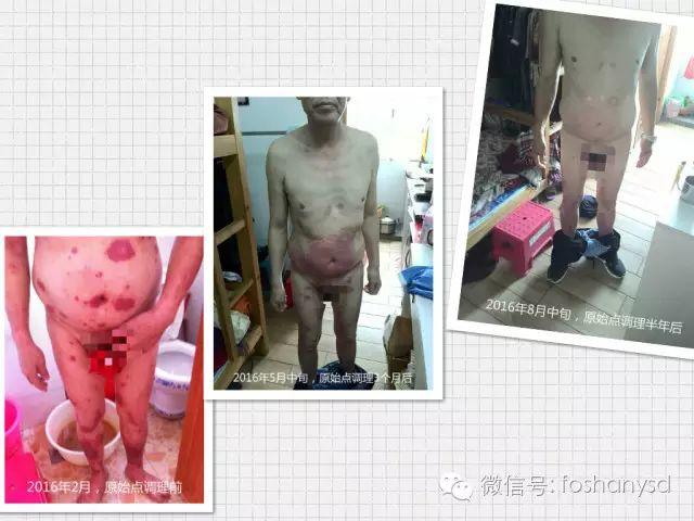 触目惊心  原始点调理八年病史牛皮癣，半年基本恢复健康