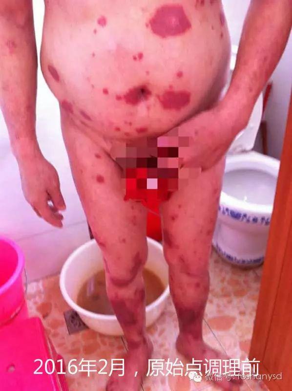 触目惊心  原始点调理八年病史牛皮癣，半年基本恢复健康