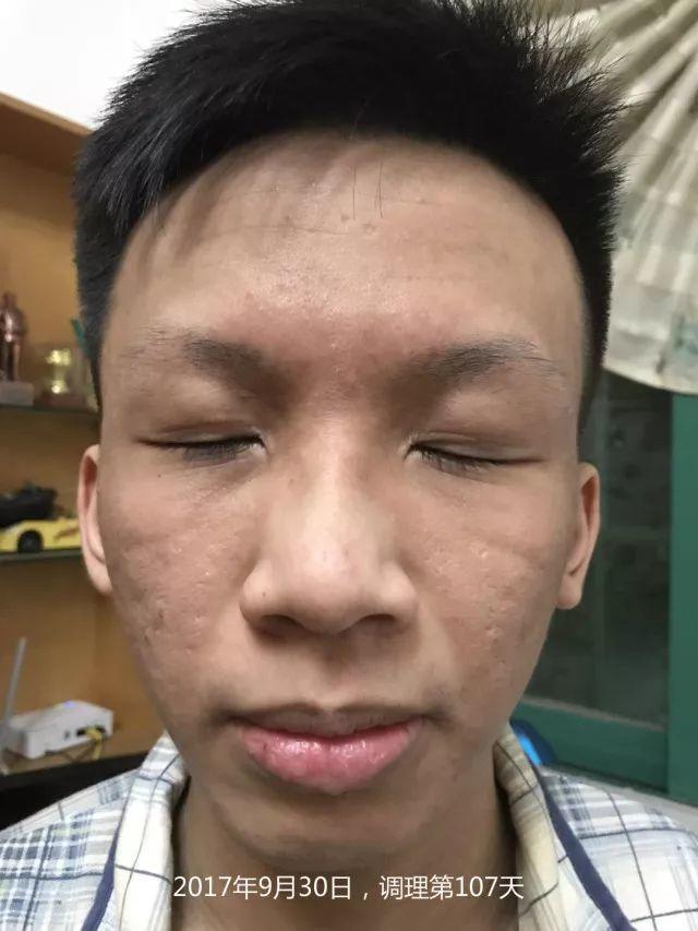 原始点调理严重湿疹:找回帅气的自己 原始点调理严重湿疹:找回帅气的自己