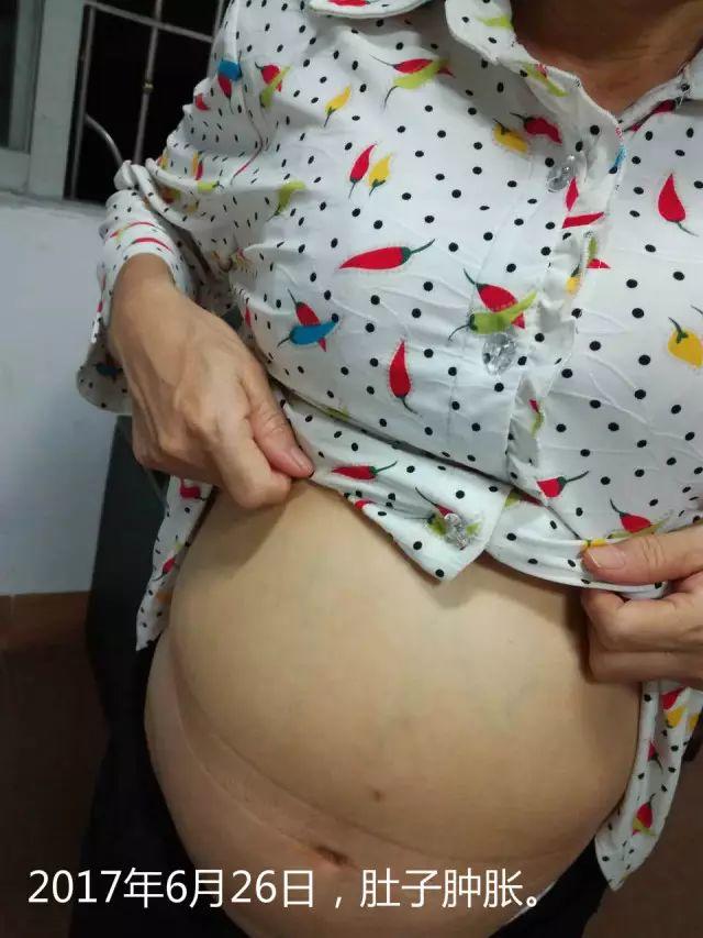 原始点调理腹水双下肢水肿：清晰的观念+信心 成就健康