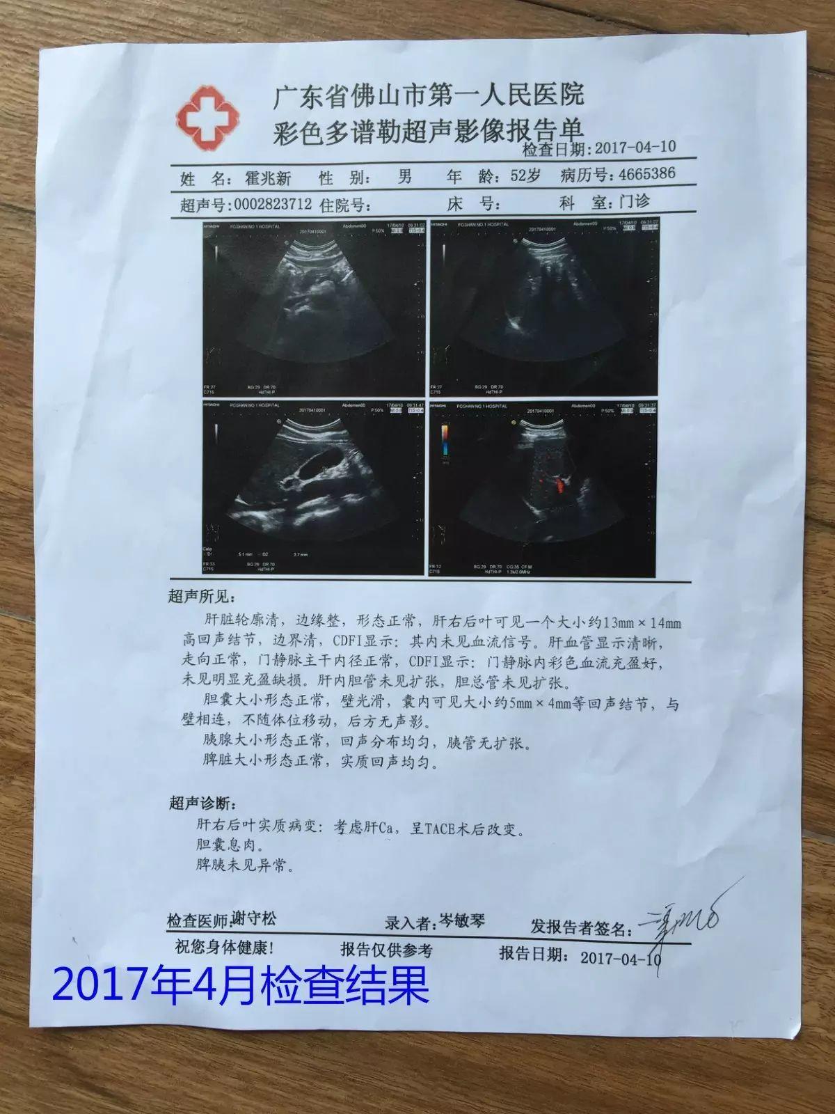 原始点调理肝癌三年后回访录：霍兆新