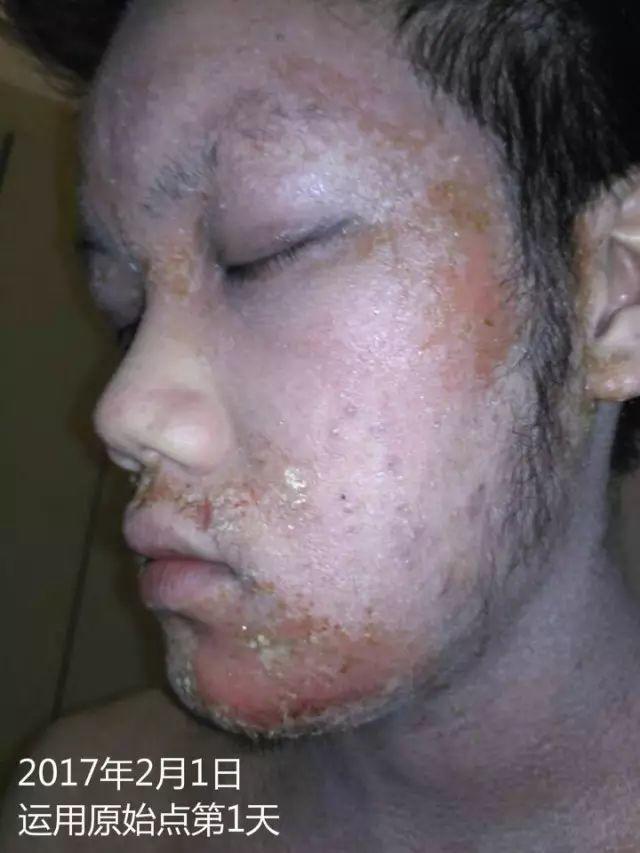 原始点调理23年严重湿疹:《21天的震撼》 原始点调理23年严重湿疹:《21天的震撼》