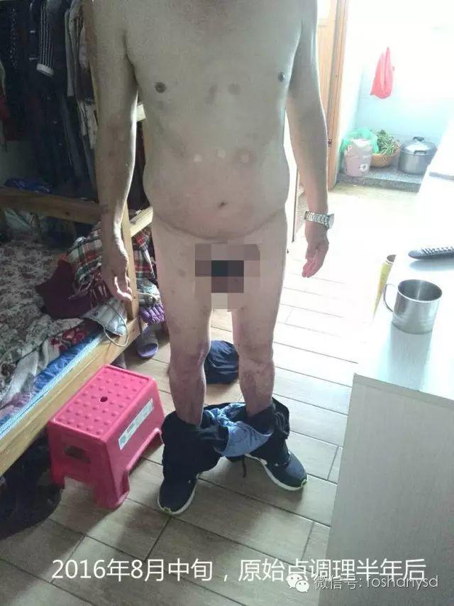 触目惊心  原始点调理八年病史牛皮癣，半年基本恢复健康