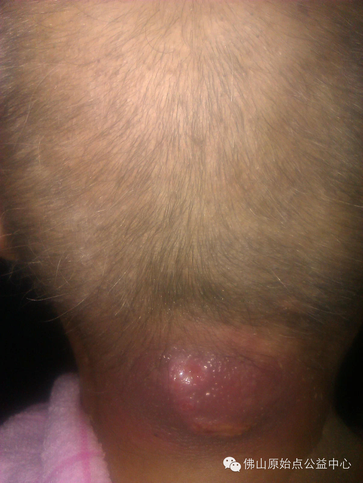 十几年对口疮  原始点调理27天康复