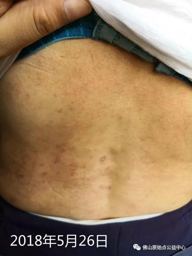 原始点调理带状疱疹:轻松快捷效果好 原始点调理带状疱疹:轻松快捷效果好