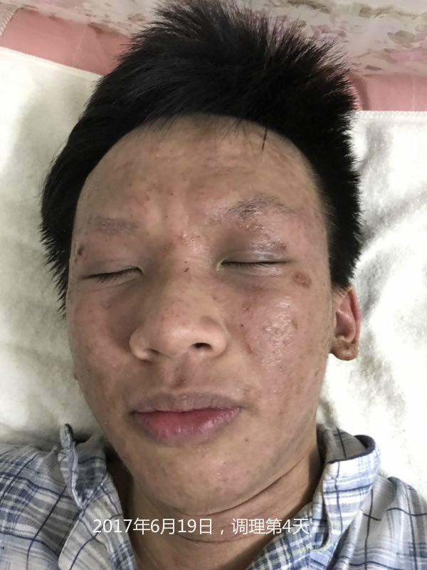 原始点调理严重湿疹:找回帅气的自己 原始点调理严重湿疹:找回帅气的自己