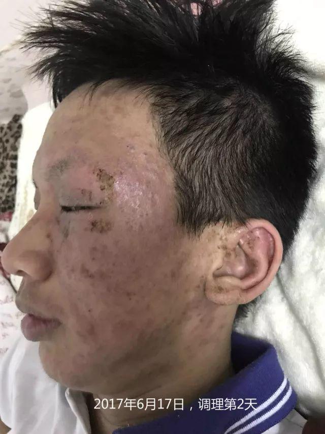 原始点调理严重湿疹:找回帅气的自己 原始点调理严重湿疹:找回帅气的自己