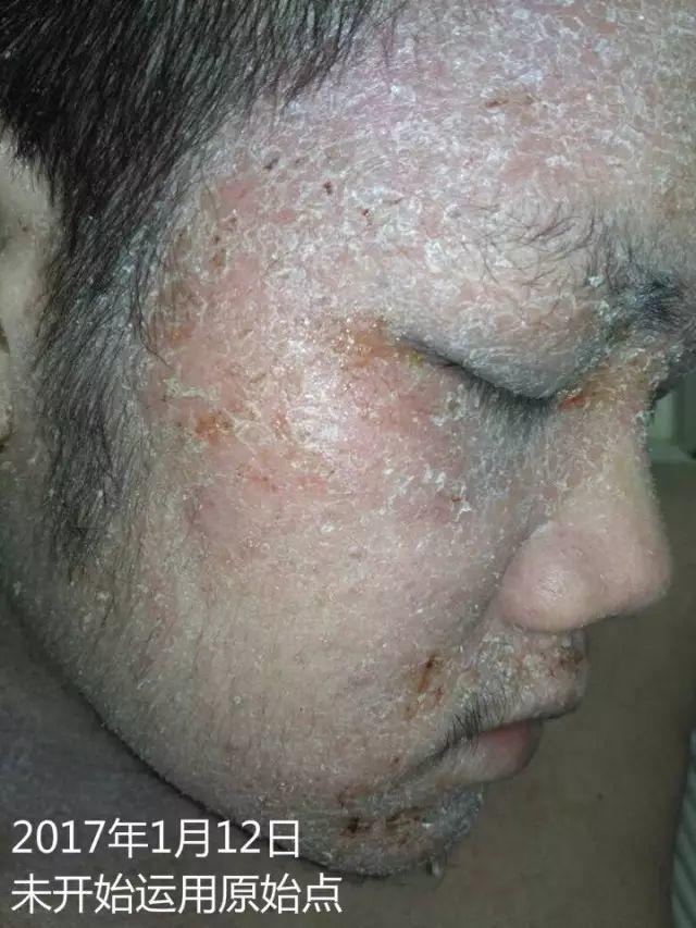 原始点调理23年严重湿疹:《21天的震撼》 原始点调理23年严重湿疹:《21天的震撼》