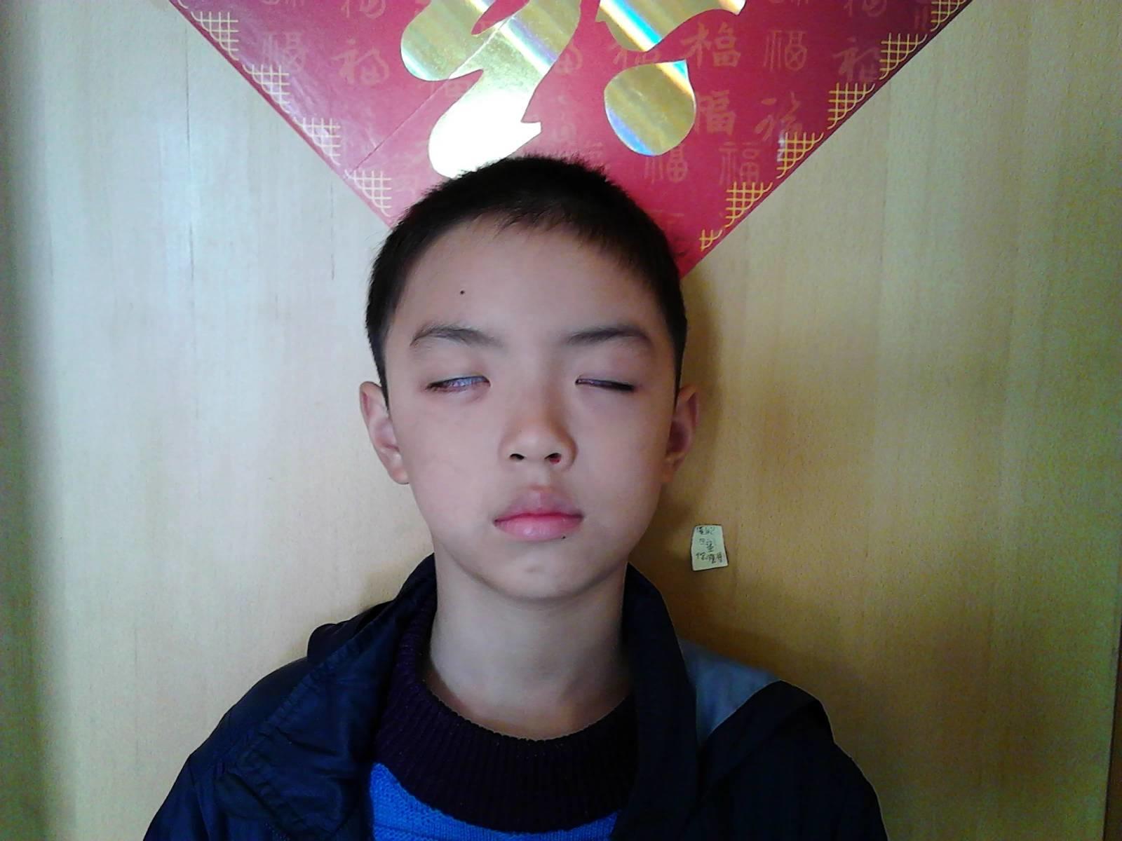 用原始点理疗病毒性脑炎后遗症三个月好了一大半