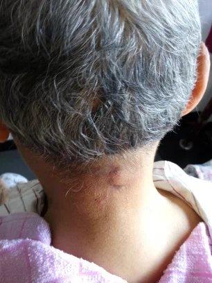 十几年对口疮  原始点调理27天康复