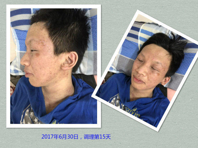 原始点调理严重湿疹:找回帅气的自己 原始点调理严重湿疹:找回帅气的自己