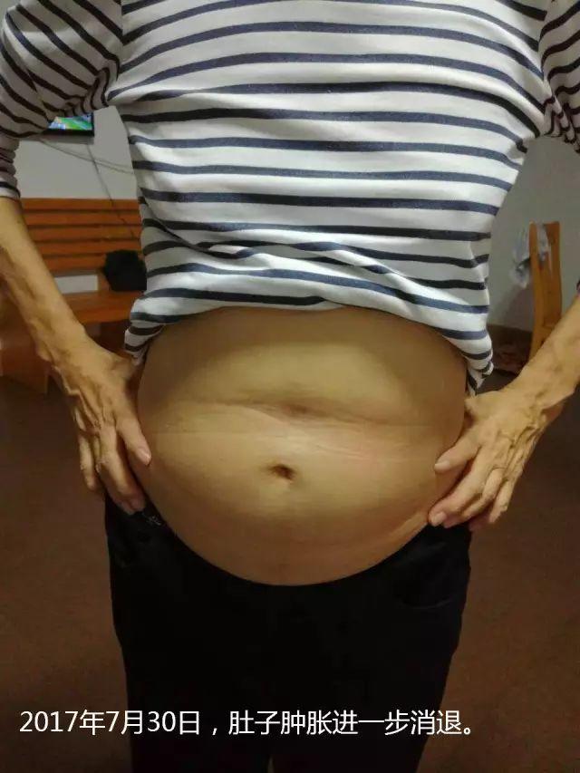 原始点调理腹水双下肢水肿：清晰的观念+信心 成就健康