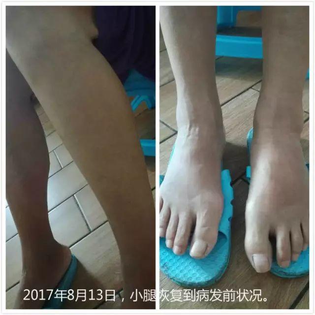 原始点调理腹水双下肢水肿：清晰的观念+信心 成就健康