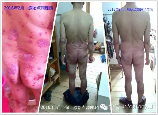 触目惊心  原始点调理八年病史牛皮癣，半年基本恢复健康