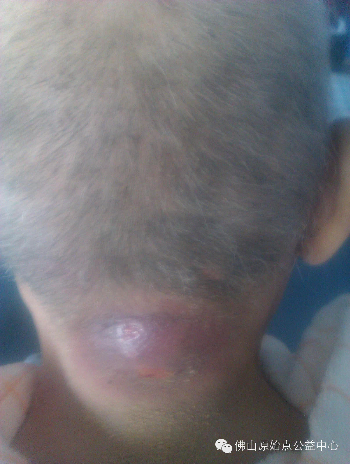 十几年对口疮  原始点调理27天康复