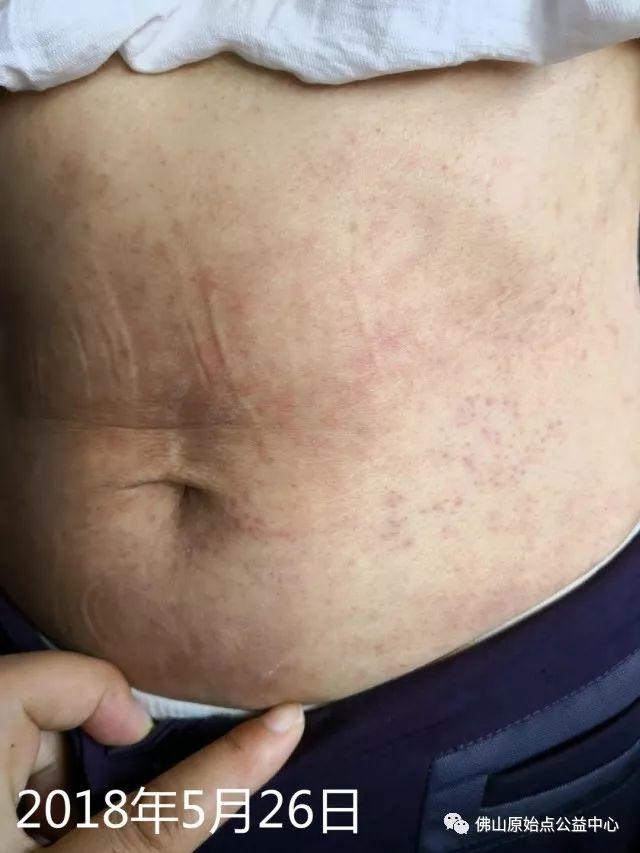 原始点调理带状疱疹:轻松快捷效果好 原始点调理带状疱疹:轻松快捷效果好