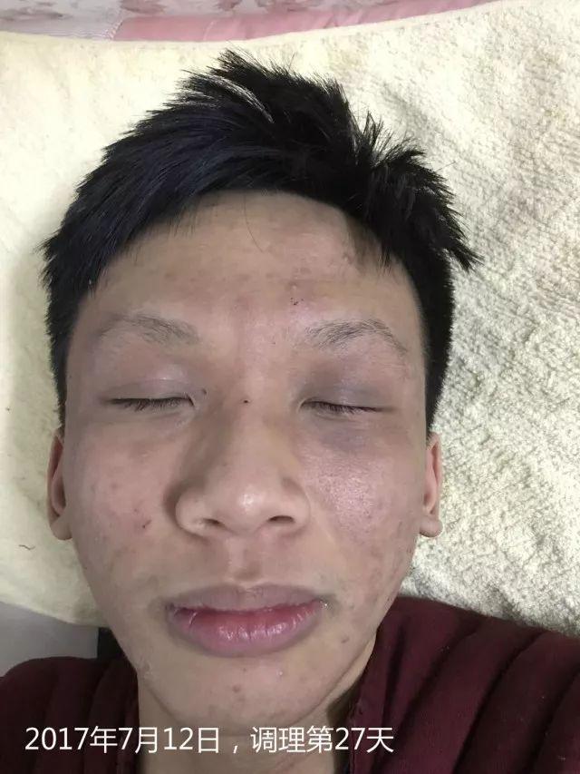 原始点调理严重湿疹:找回帅气的自己 原始点调理严重湿疹:找回帅气的自己