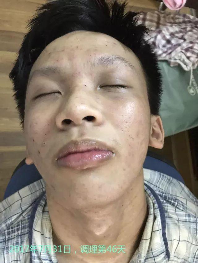 原始点调理严重湿疹:找回帅气的自己 原始点调理严重湿疹:找回帅气的自己