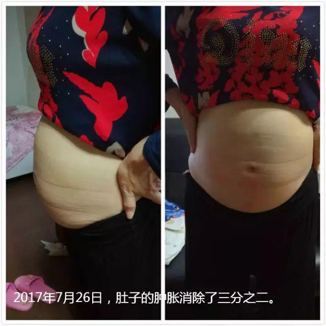 原始点调理腹水双下肢水肿：清晰的观念+信心 成就健康