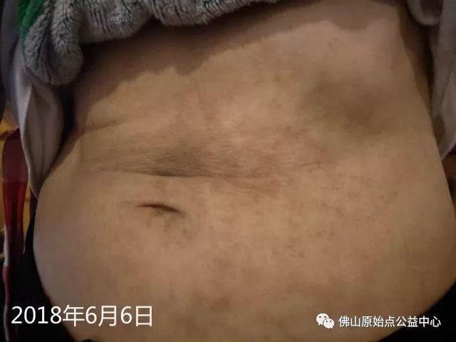 原始点调理带状疱疹:轻松快捷效果好 原始点调理带状疱疹:轻松快捷效果好