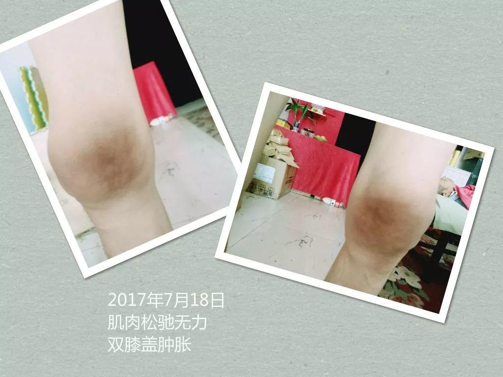 原始点调理手脚肿胀、极度疼痛:《好转来得如此快》 原始点调理手脚肿胀、极度疼痛:《好转来得如此快》
