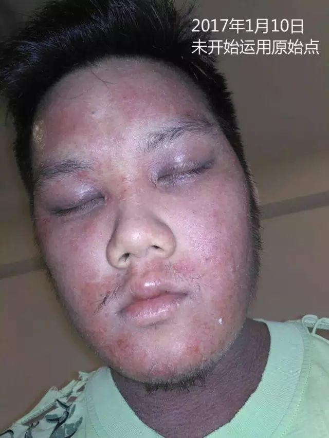 原始点调理23年严重湿疹:《21天的震撼》 原始点调理23年严重湿疹:《21天的震撼》