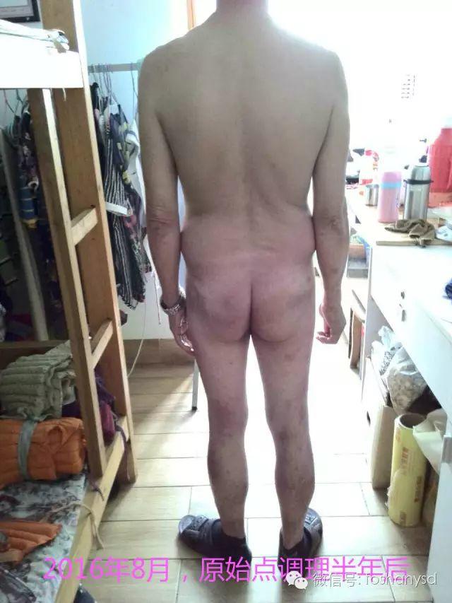 触目惊心  原始点调理八年病史牛皮癣，半年基本恢复健康